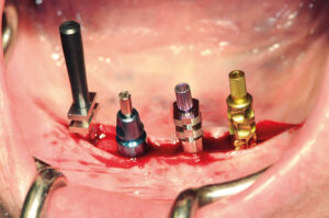 Das Prinzip Konuskrone in der Implantologie