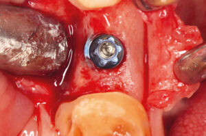 Erhalt des zirkulären Hart- und Weichgewebes durch die Design-Merkmale des Implantatsystems