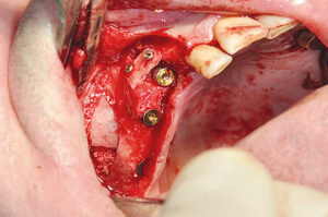 Sinusbodenelevation mit sagittal transversaler und vertikaler Knochenaugmentation