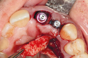 Rekonstruktion der Interdentalpapille zwischen zwei benachbarten Implantaten im ästhetisch sichtbaren Bereich