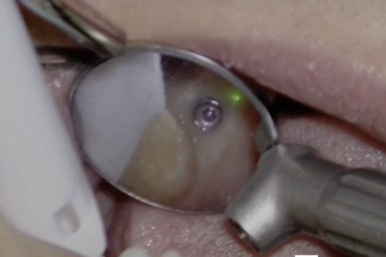 Implantatfreilegung mit dem Solea-Laser
