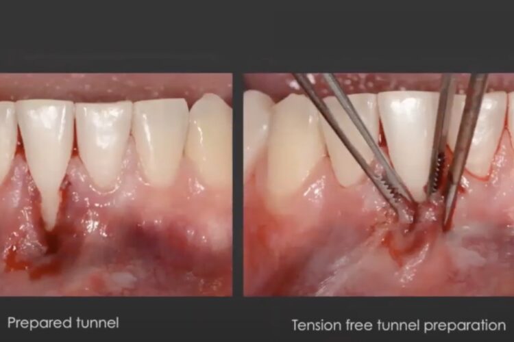 Hyaluronsäure in der Regenerativen und Plastischen Äesthetischen Parodontalchirurgie