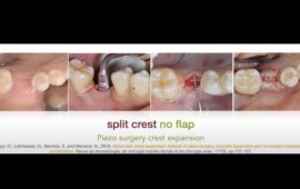 Digital Guided & Flapless Implantology – Main treatment option after the pandemic?
