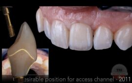 Simone Maffei: Digital Implant Dentistry from a Laboratory Perspective