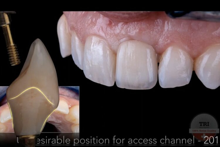 Simone Maffei: Digital Implant Dentistry from a Laboratory Perspective