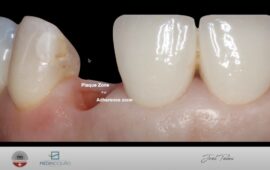 Session 1: Immediate placement and immediate loading – Single crown from molar to high esthetic region