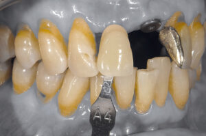 Implantation im parodontal kompromittierten Gebiss