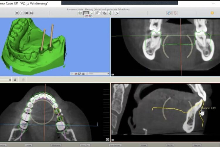 Implantologie im digitalen Workflow mit SMOP