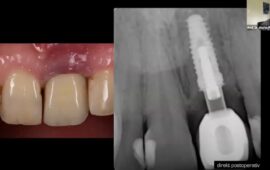Komplikationsprävention bei parodontologischen und oralchirurgischen Eingriffen – Teil 2