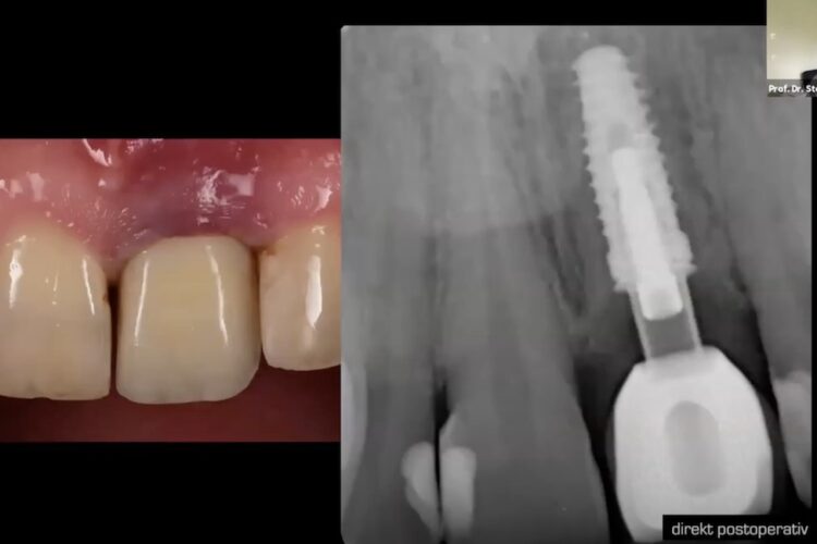 Komplikationsprävention bei parodontologischen und oralchirurgischen Eingriffen – Teil 2