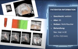 ICX-WEBINAR: Navigierte Implantologie – Eine Einführung in die Praxis