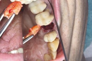 Sofortimplantation bei parodontal kompromittierter Ausgangssituation