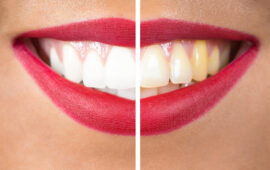 weißere Zähne