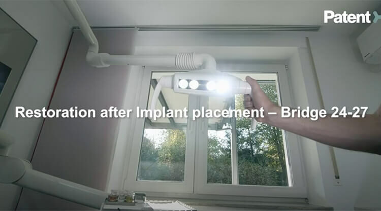 Restoration after Patent™ Implant Placement