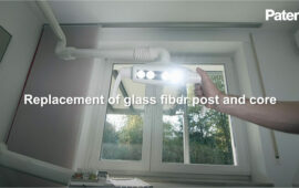 Replacement of Patent™ Glass Fiber Post