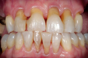 Vier-Quadranten-Rehabilitation nach parodontal-funktioneller und kariöser Schädigung