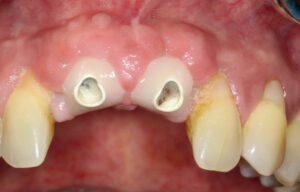 Vollkeramischer Implantatersatz bei parodontal stark vorgeschädigten Frontzähnen