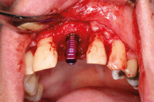 Implantatprothetische Versorgung nach Yxoss CBR 