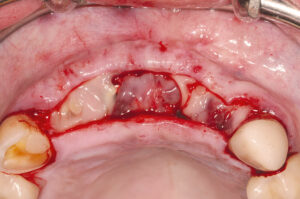 Zahn- und Kieferfehlstellungsbedingte implantologische Versorgungskonzepte