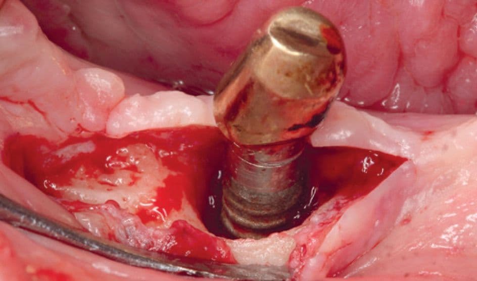 Periimplantitis