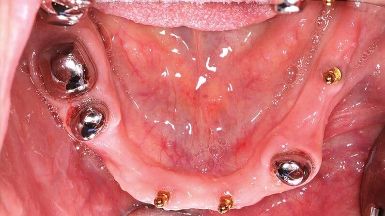 Miniimplantate Adjmal Sheerzoi