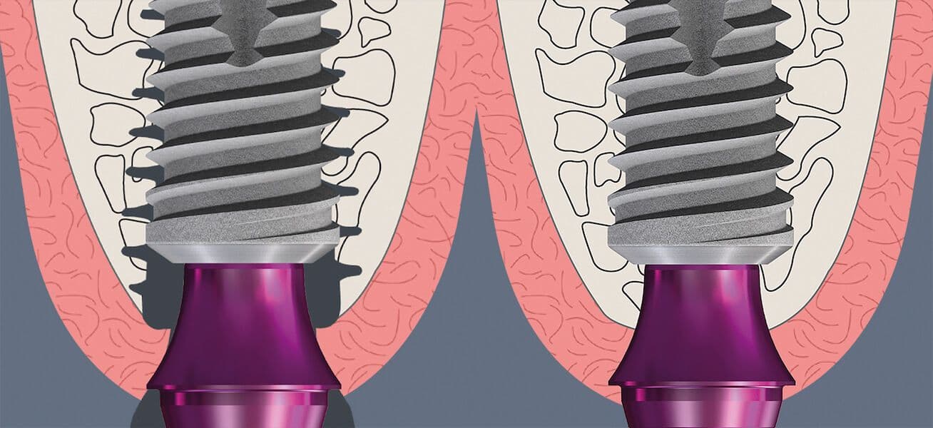 Bone Growth Concept