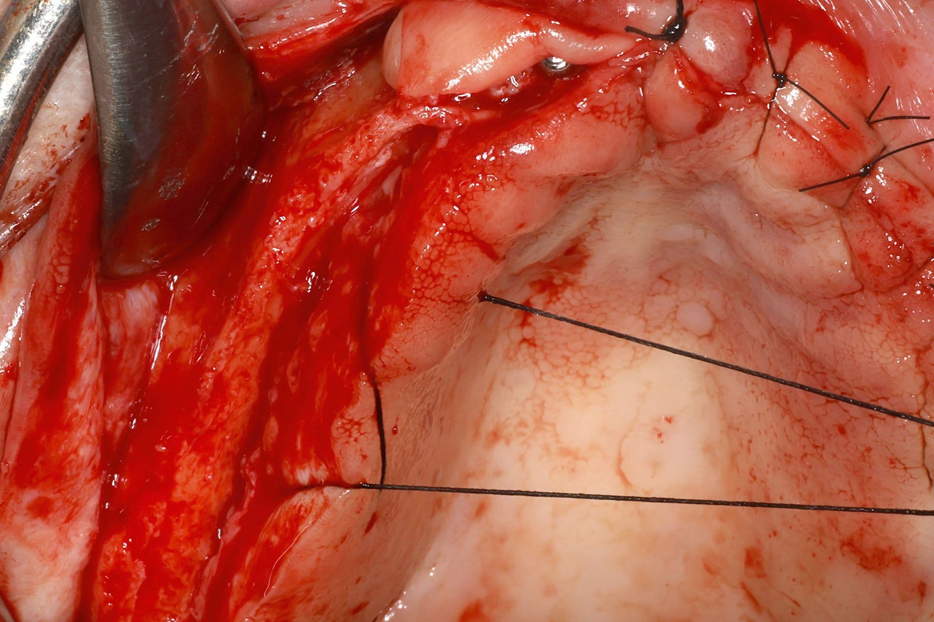 Abbildung 18: Einsetzen von Implantaten mit 2,5 mm Durchmesser, gefolgt von einer Überkorrektur der Kieferkammbreite mit autologem Knochen, der durch Knochenpräparation gewonnen wurde (hauptsächlich aus dem Einsetzen von Implantaten im Unterkiefer), kombiniert mit PRGF-Endoret und einer dünnen Schicht Biomaterial (bovines Hydroxylapatit), das ebenfalls mit PRGF-Endoret eingebracht wurde.