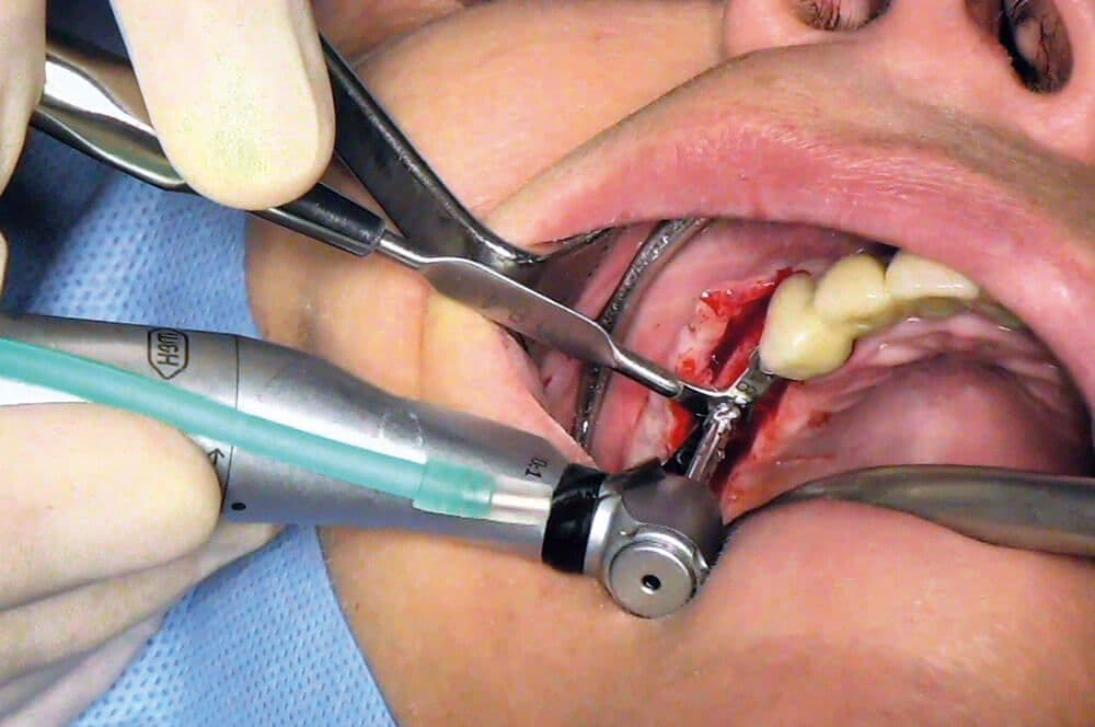 Ultrakurze Implantate im Molarenbereich