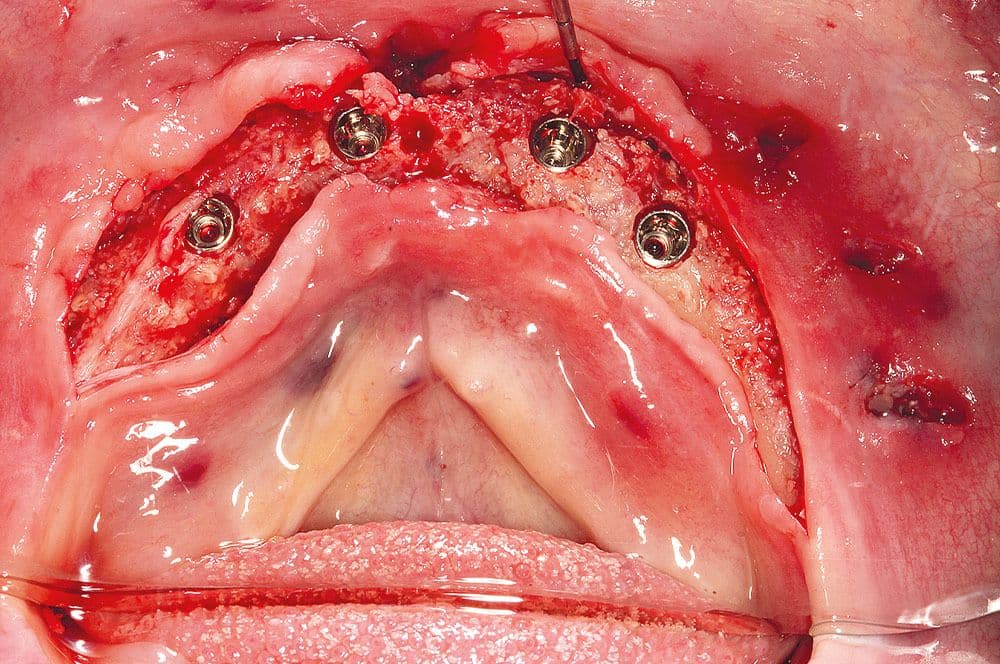 Implantation von vier Implantaten nach sechs Monaten Einheilzeit für das Augmentat.