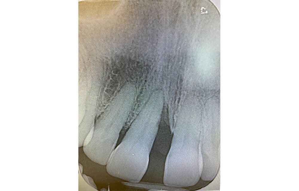 Abb. 1 Ein Röntgenbild offenbarte einen starken Knochenabbau mesial 11. Zusätzlich zeigte sich die Wurzel entzündet und der Zahn war somit nicht mehr erhaltungswürdig.