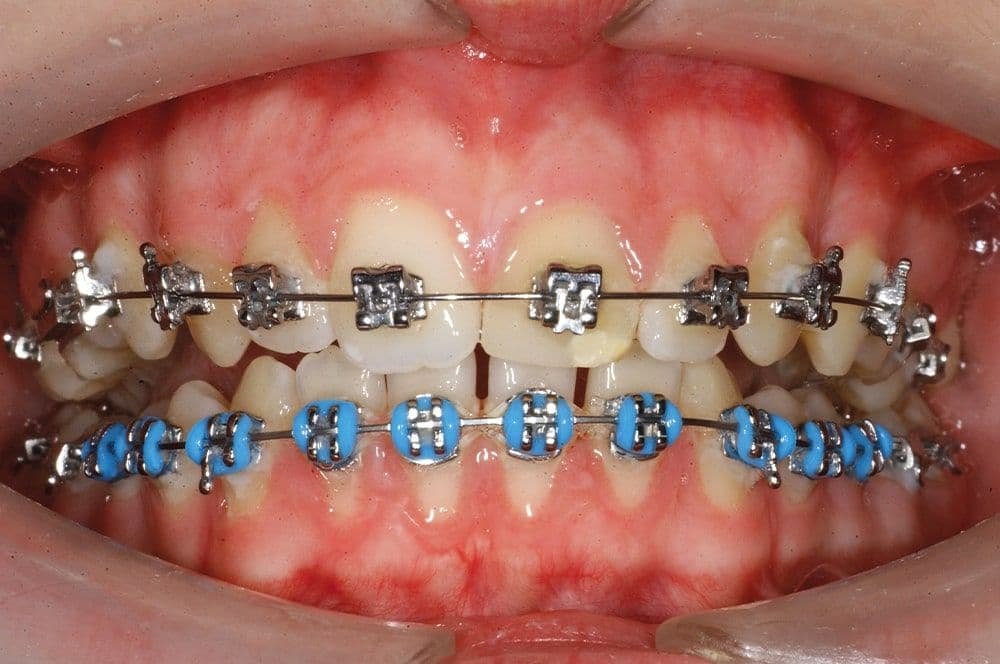 Abb1: Klinische Situation zu Beginn der kieferorthopädischen Behandlung im Jahr 2011.