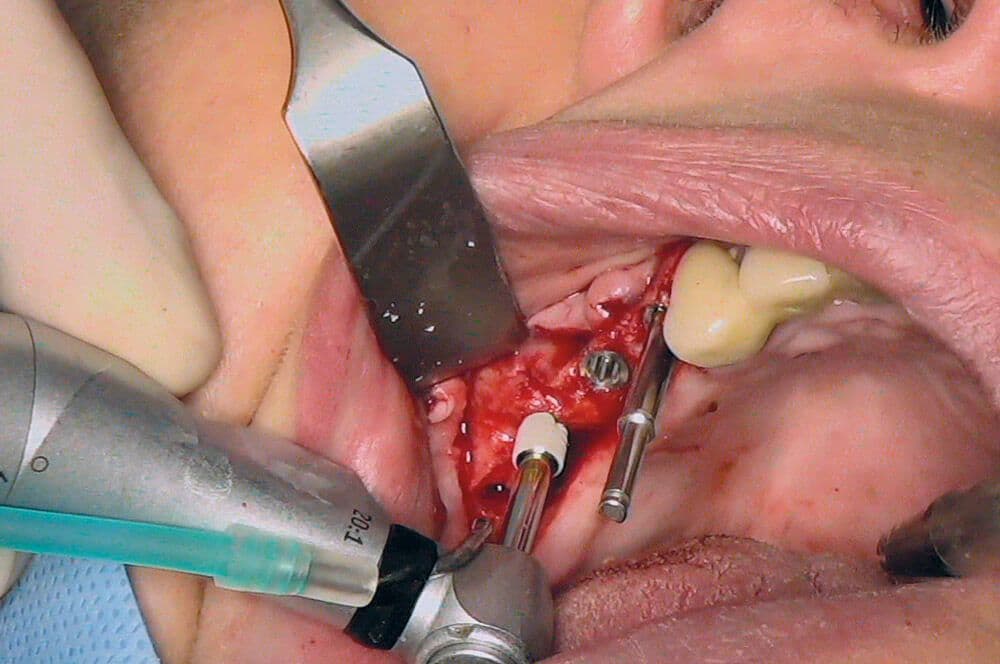 Ultrakurze Implantate im Molarenbereich