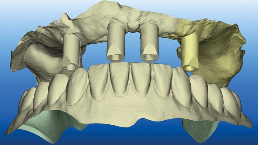 Zweiteilige Keramikimplantate