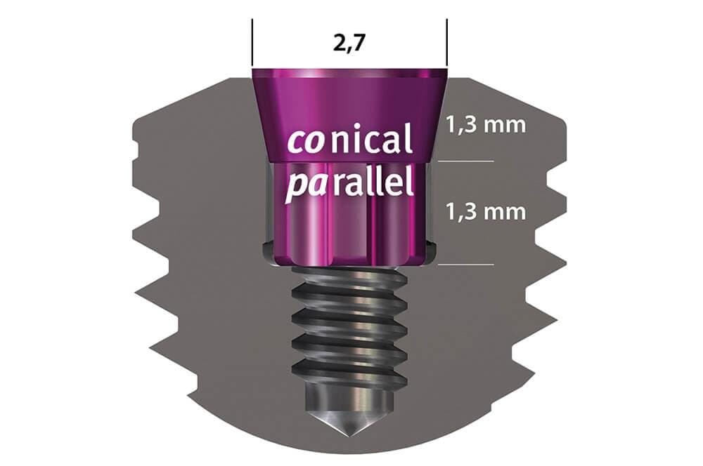 Ultrakurze Implantate im Molarenbereich