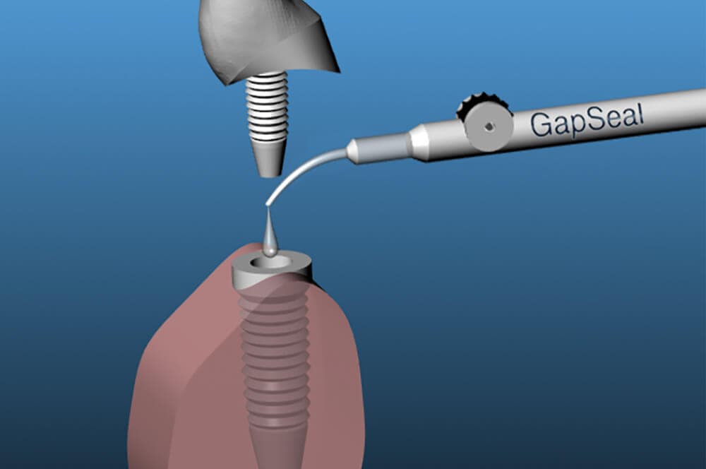 GapSeal