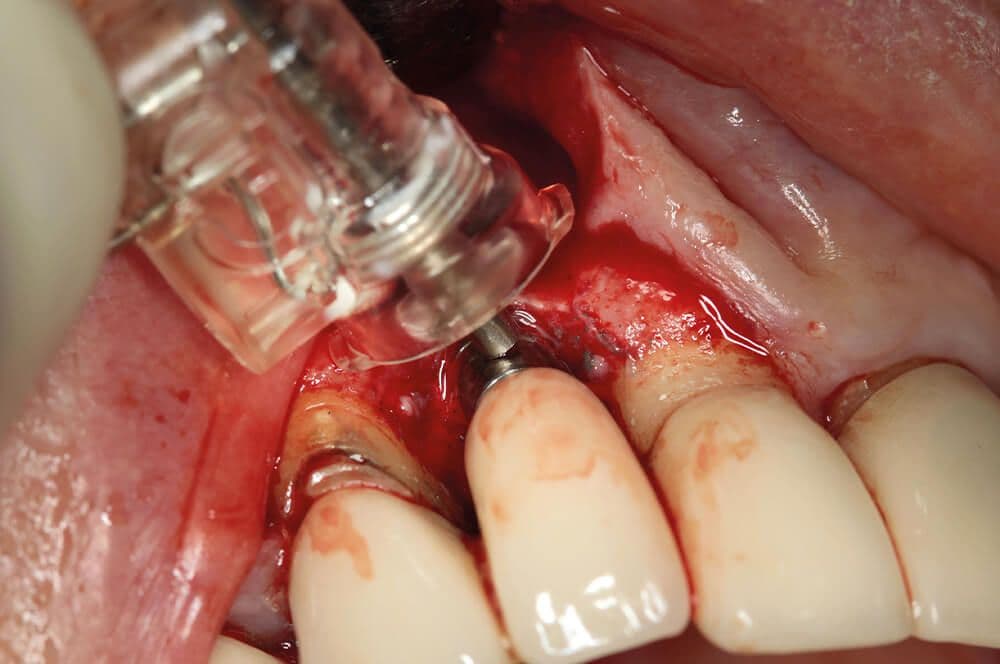Periimplantitis-Therapie in der Periimplantitis-Therapie in der ästhetischen Zone