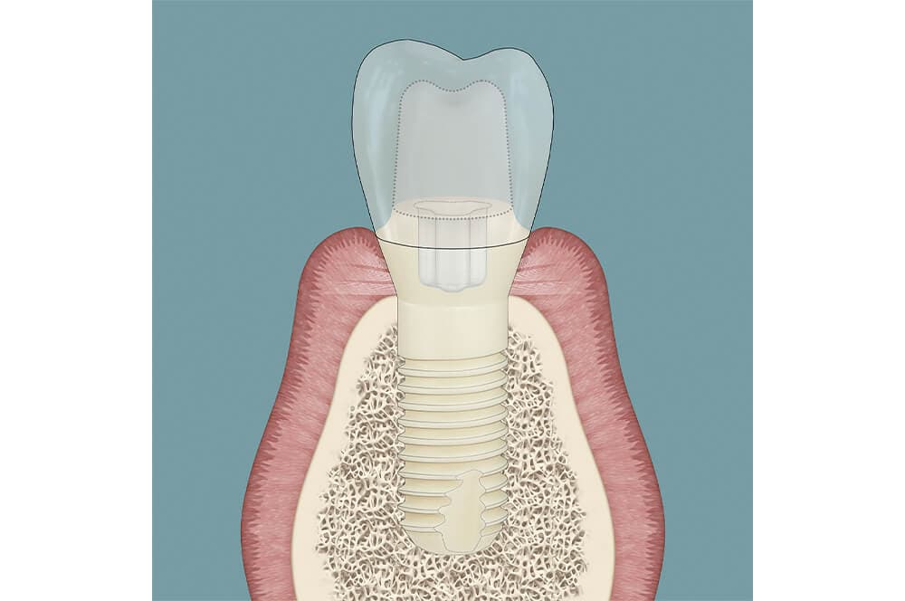 Periimplantitis