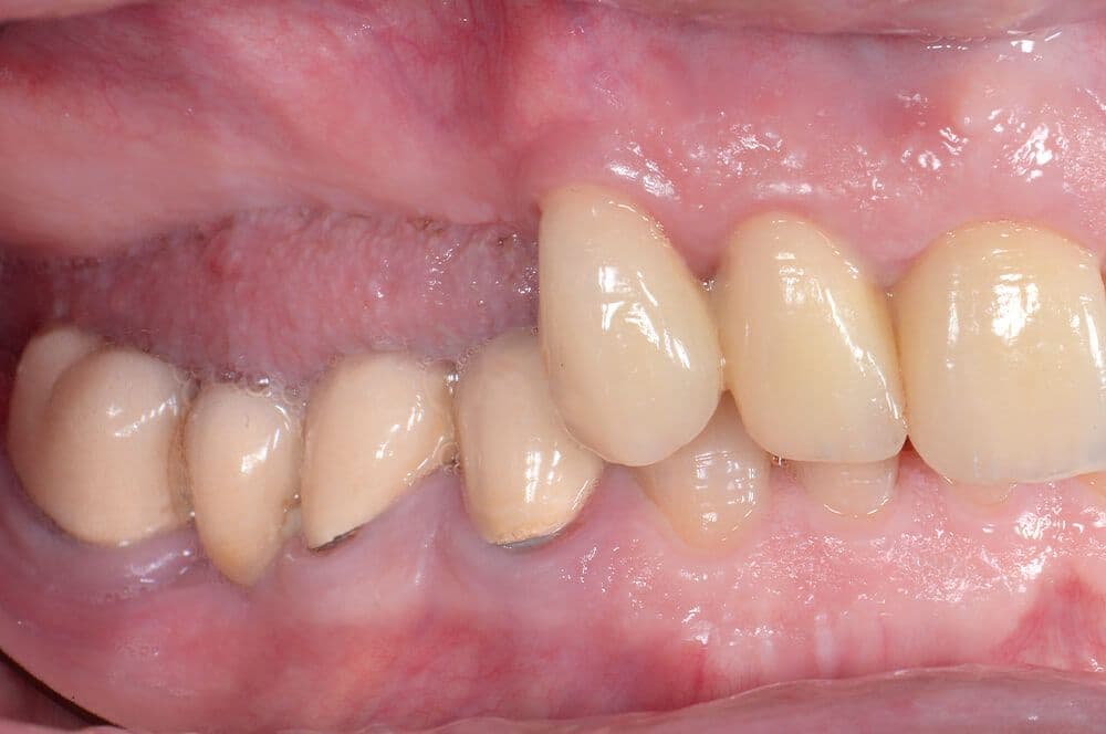 1: Klinische Ausgangssituation der Patientin im Oberkiefer von lateral.
