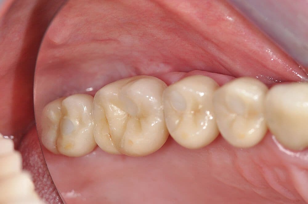 Ultrakurze Implantate im Molarenbereich