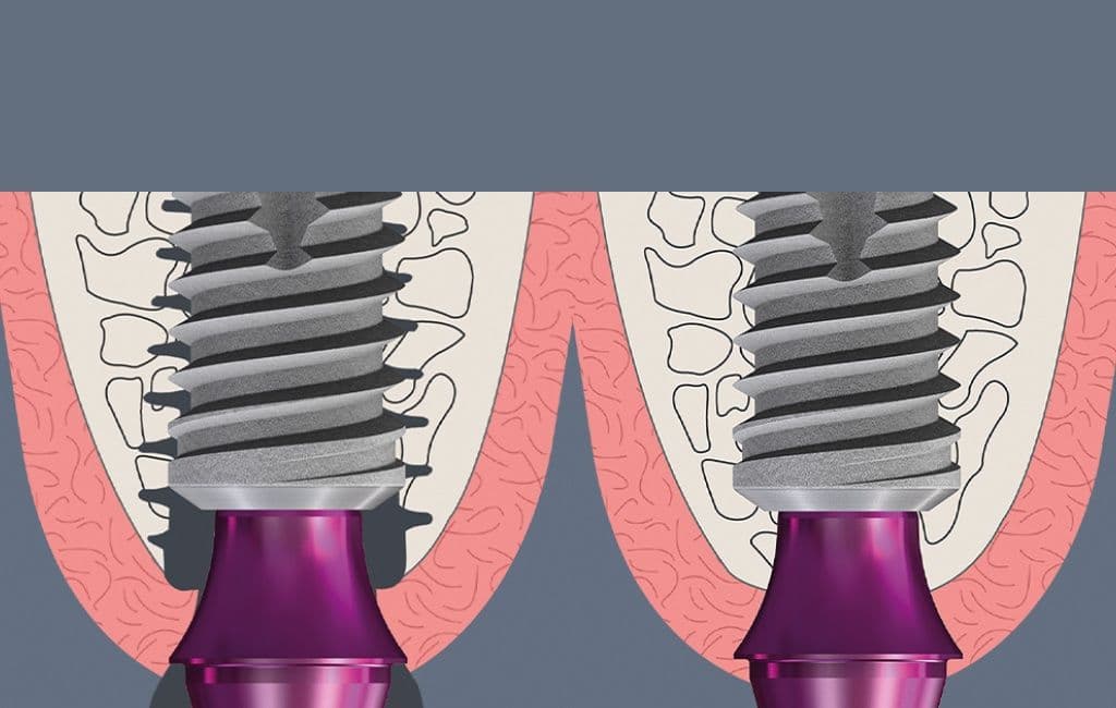 Bone Growth Concept