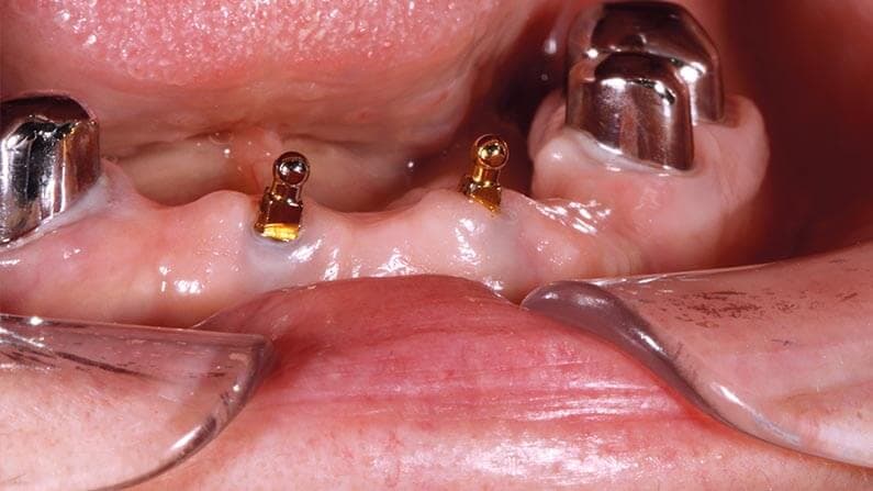 Miniimplantate Adjmal Sheerzoi