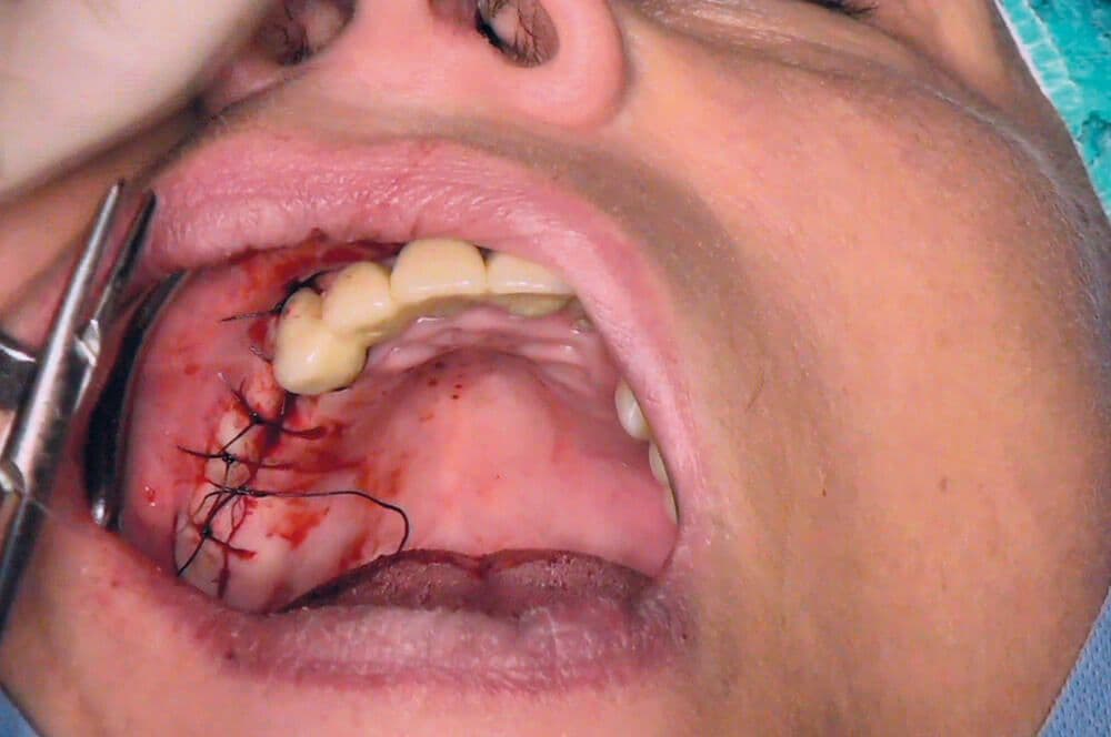 Ultrakurze Implantate im Molarenbereich
