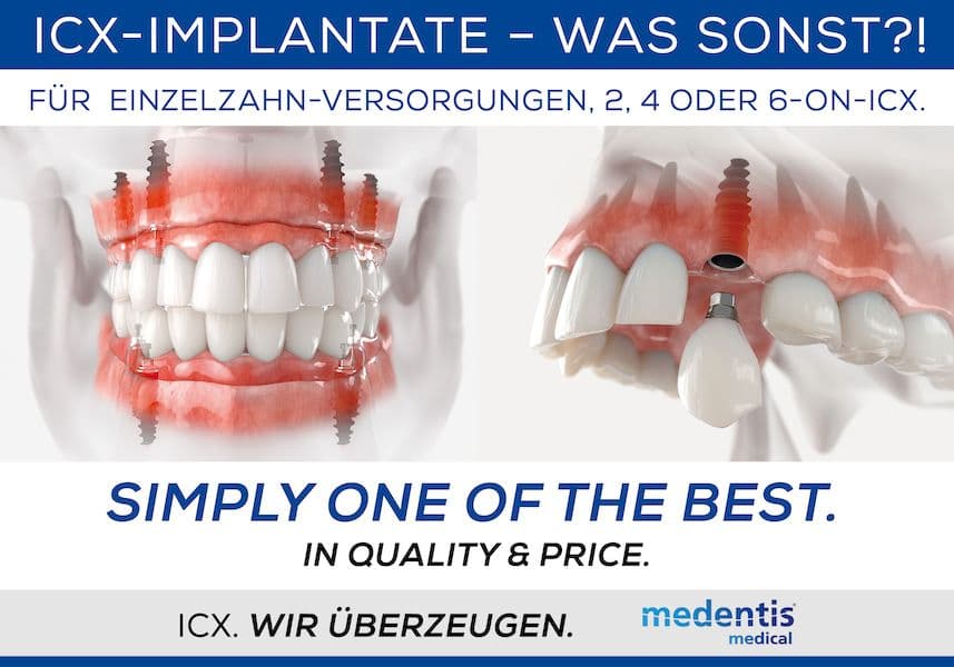ICX-Implantate