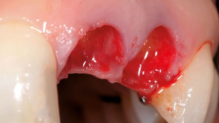 Minimaltraumatische Implantatbett Gestaltung
