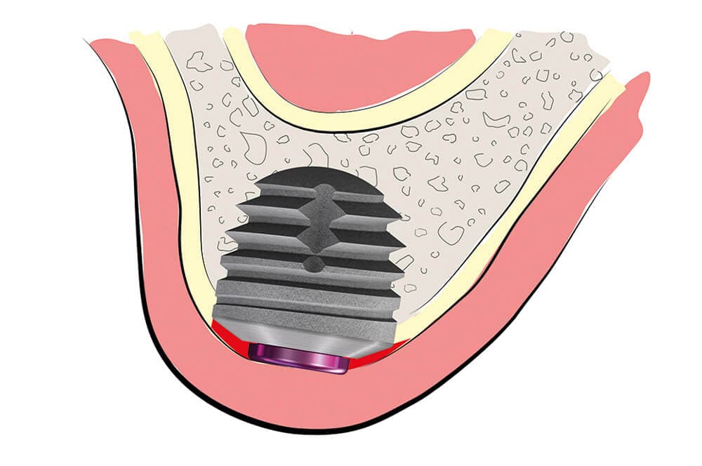 Ultrakurze Implantate im Molarenbereich