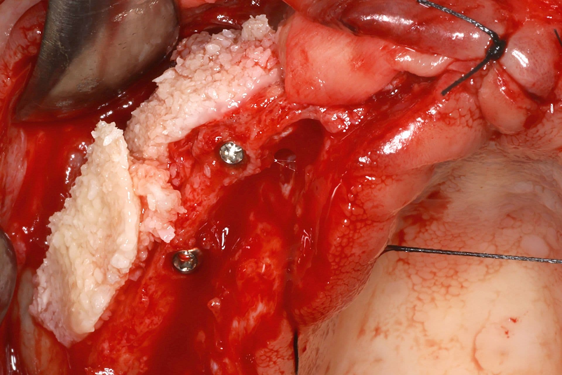 Abbildung 21: Einsetzen von Implantaten mit 2,5 mm Durchmesser, gefolgt von einer Überkorrektur der Kieferkammbreite mit autologem Knochen, der durch Knochenpräparation gewonnen wurde (hauptsächlich aus dem Einsetzen von Implantaten im Unterkiefer), kombiniert mit PRGF-Endoret und einer dünnen Schicht Biomaterial (bovines Hydroxylapatit), das ebenfalls mit PRGF-Endoret eingebracht wurde.