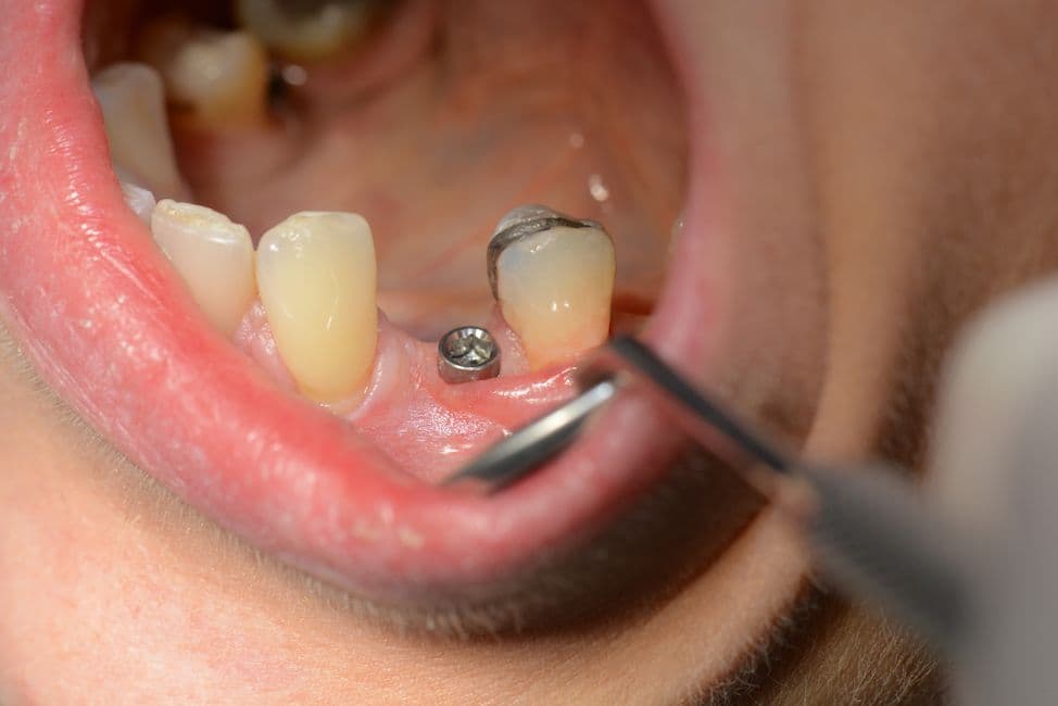 Champions Implants