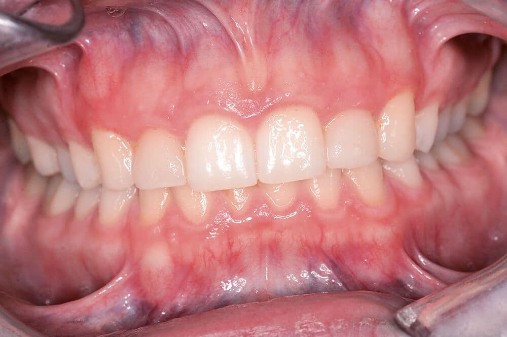 Abb 1: Patientin in habitueller Interkuspidation, schief fotografiert oder schief gewachsen?