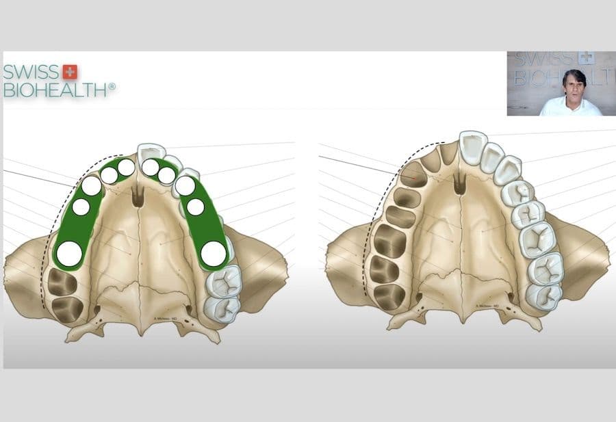 Implantatanzahl
