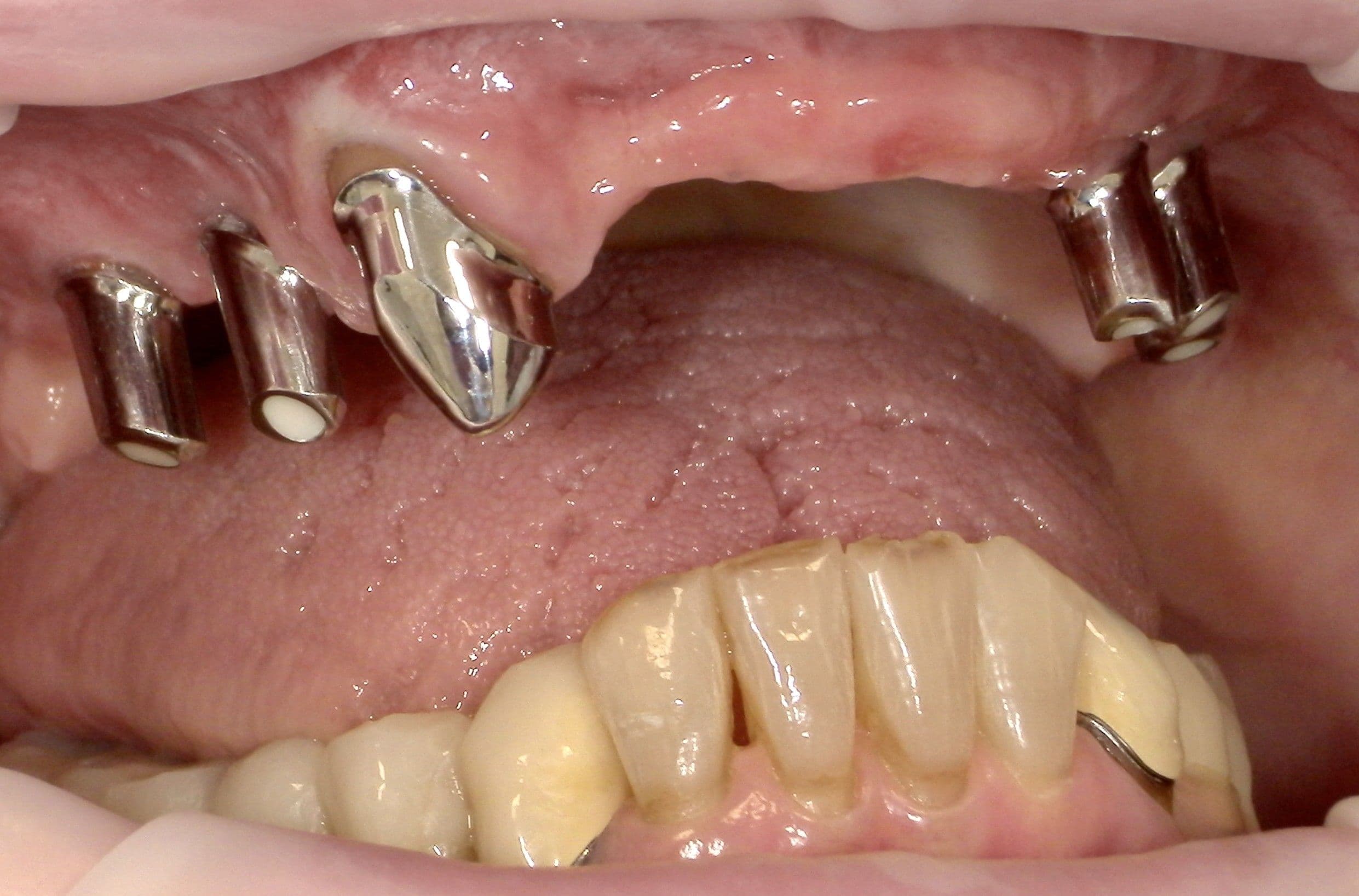 Primärteleskope auf Implantaten und natürlicher Restbezahnung.
